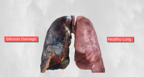 silicosis lung from tile dust